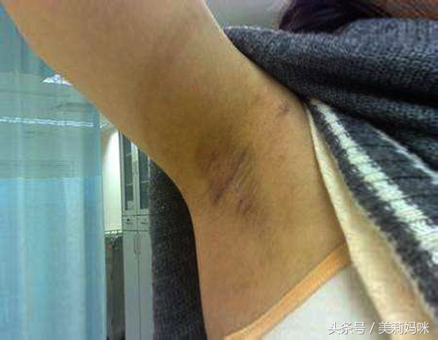 怀孕腋下变黑胸变黑脖子有黑颈纹,孕期脖子腋下发黑图片