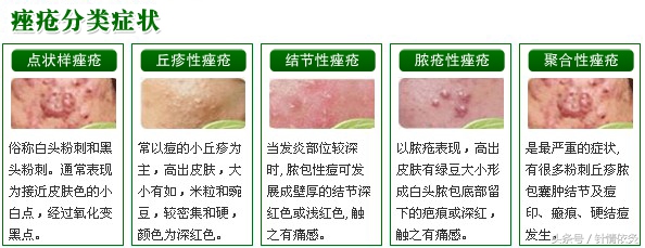 针灸治面部痤疮,针灸治疗疔疮