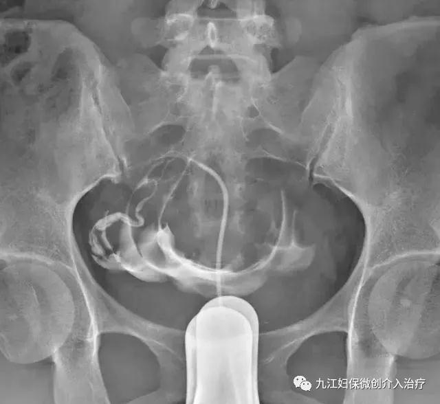 输卵管臭氧介入治疗和造影剂,介入治疗输卵管堵塞需要打麻药嘛