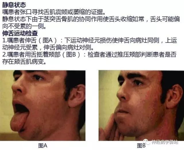 舌下神经和舌咽神经的解剖图,颊神经舌神经解剖图