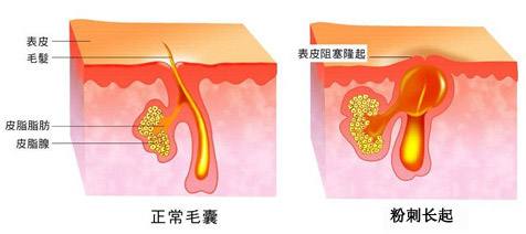 痘痘一直不好怎么办,痘痘一直反反复复怎么才能调理好