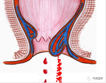 便血查出来肠癌的多吗,便血查出肠癌怎么办