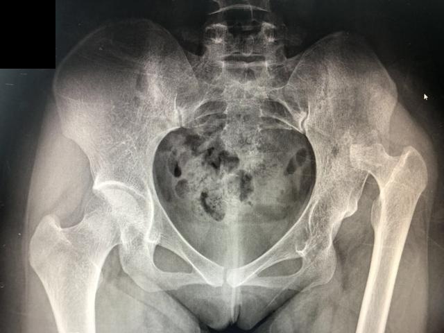 小孩臀线不对称怎么办,小孩臀纹不对称