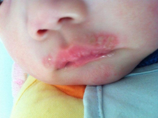 莫匹罗星软膏可以治疗嘴角起泡吗,嘴角经常上火起泡什么原因