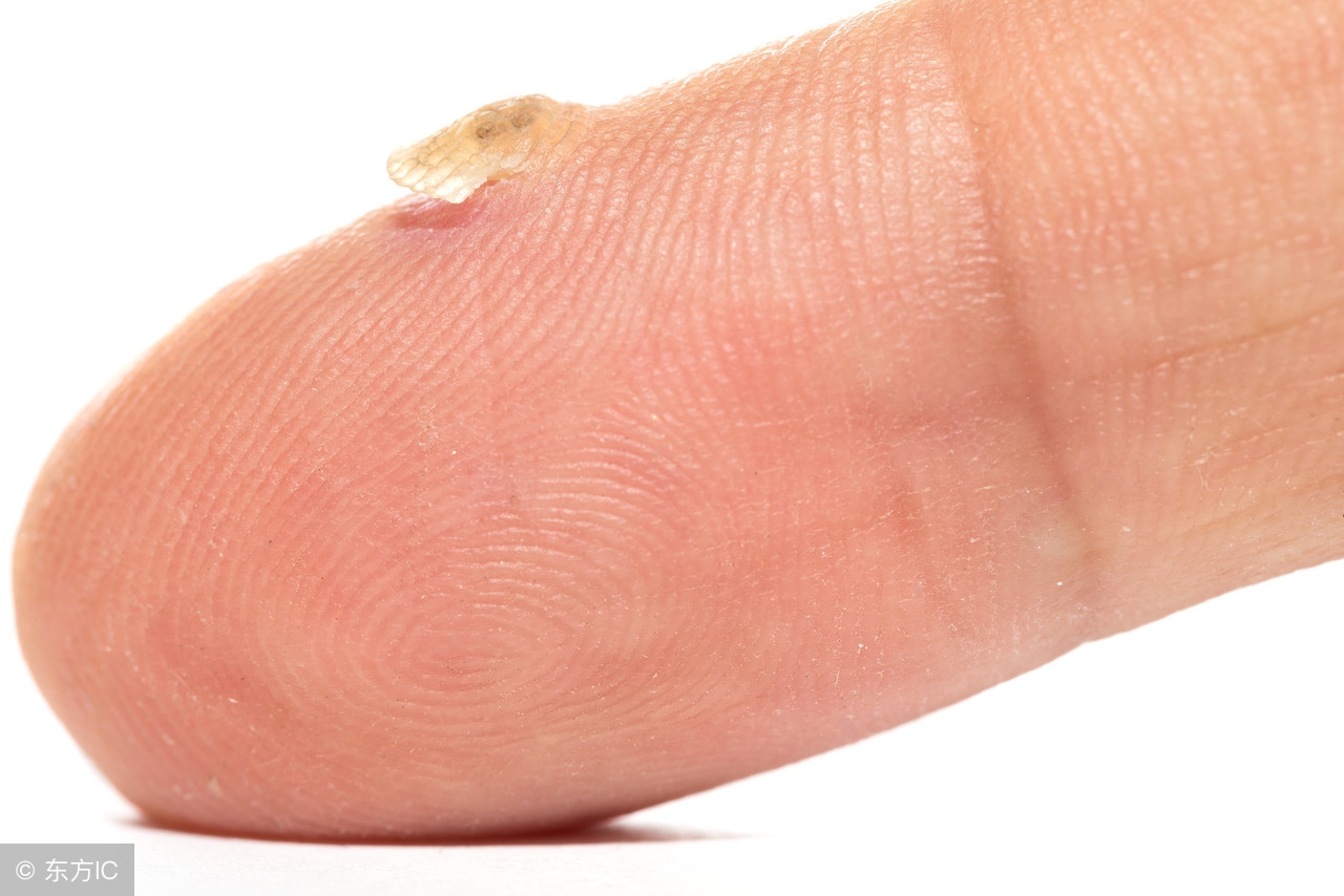 扁平疣最简单去除后怎么护理,扁平疣怎么办教你轻松解决