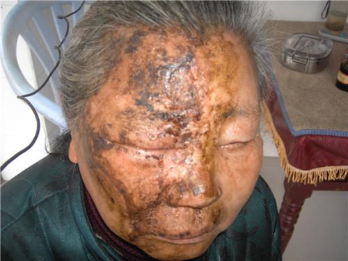 痘痘可以等它自然消失吗,痘痘消不掉有颗粒感