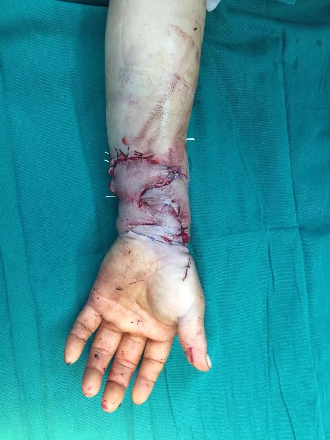 人不是壁虎，断掌断腕还能再植？枣庄市立医院为您答疑解惑！