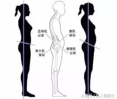 怎么才能快速有效的改变骨盆前倾,导致骨盆前倾的不良坐姿有哪些