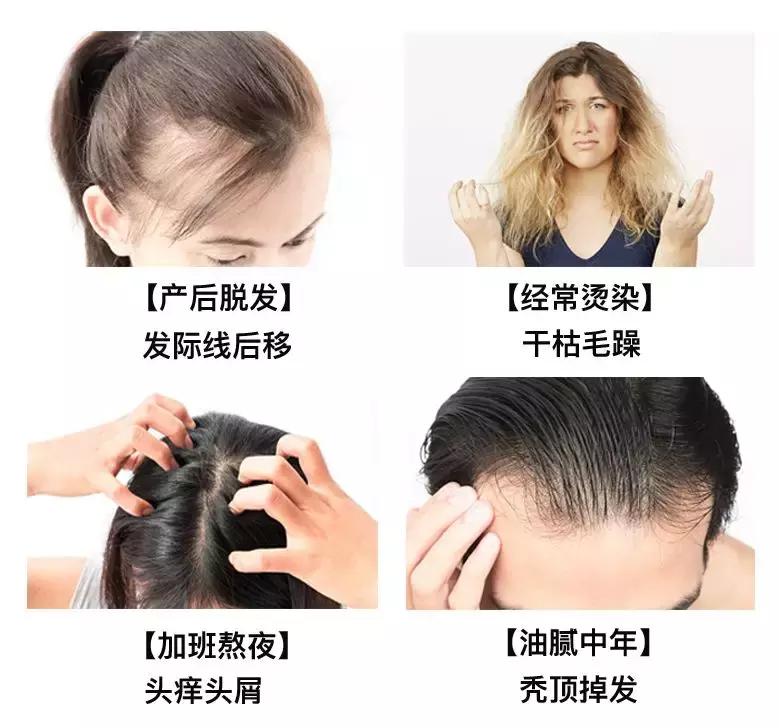 用错了水也会致掉发？不知道就太可惜了