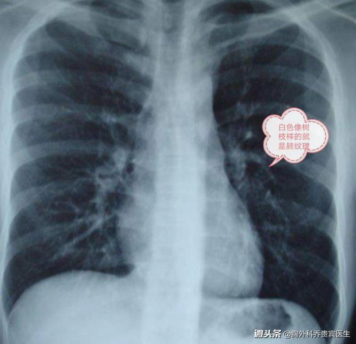肺纹理模糊是肺炎吗,肺纹理模糊什么意思