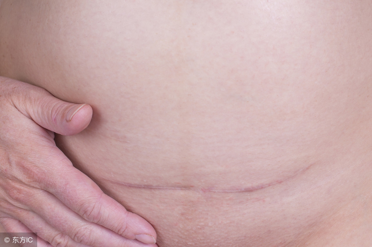 剖腹产疤痕恢复前是什么样的,剖腹产疤痕怎么弄的完全看不出