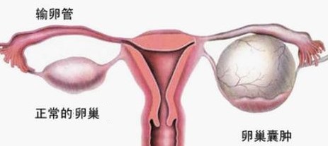 卵巢囊肿手术指征有哪些,卵巢囊肿5-6用手术吗