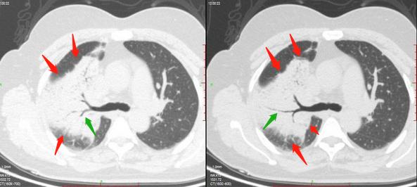 咳嗽几个月都没好会得肺癌吗,29岁女孩咳嗽一周肺癌