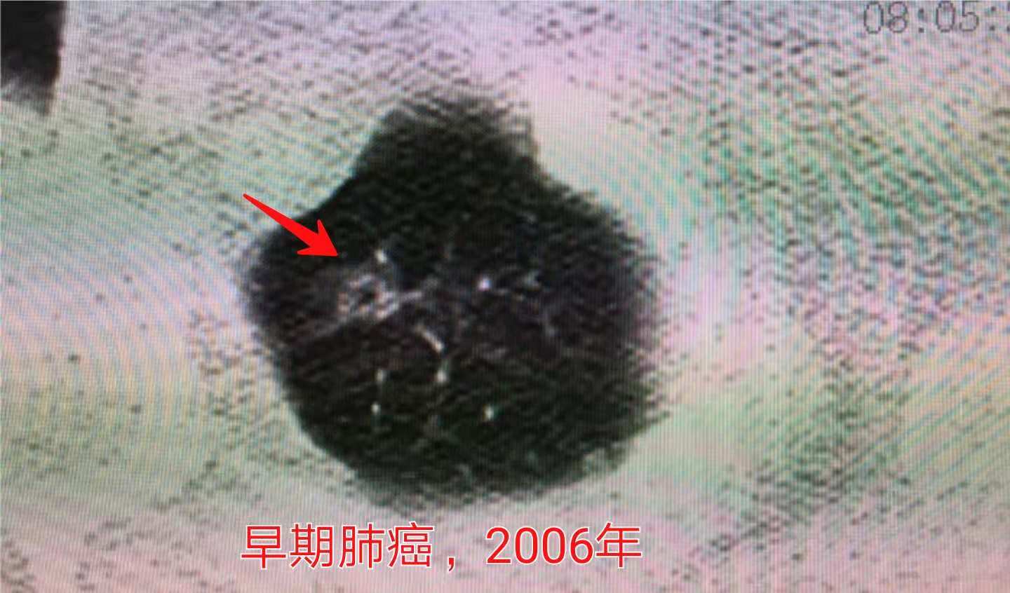 13岁女孩咳嗽半个月确定肺癌,咳嗽一个多月肺癌还有救吗