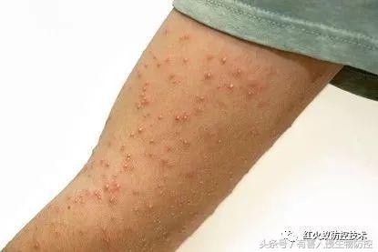 被红火蚁咬的治疗方法,被红火蚁咬后怎么处理偏方