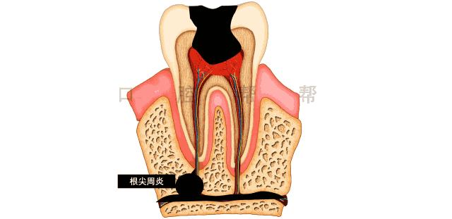蛀牙三颗算多吗,蛀牙是怎么吃掉牙齿的