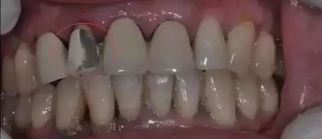 烤瓷牙与全瓷牙价格对比,烤瓷牙和全瓷牙价格差多少钱一颗