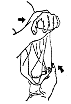 中医骨折治疗原则,中医骨伤整复术