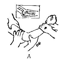 中医骨折治疗原则,中医骨伤整复术