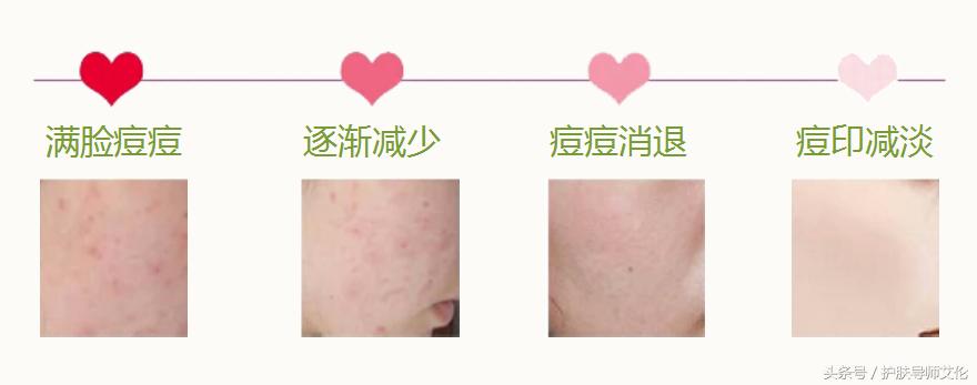 植物祛痘组合价格表,植物草本祛痘