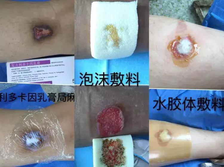 创面治疗的治疗目标及治疗策略,创面愈合的临床治疗方法