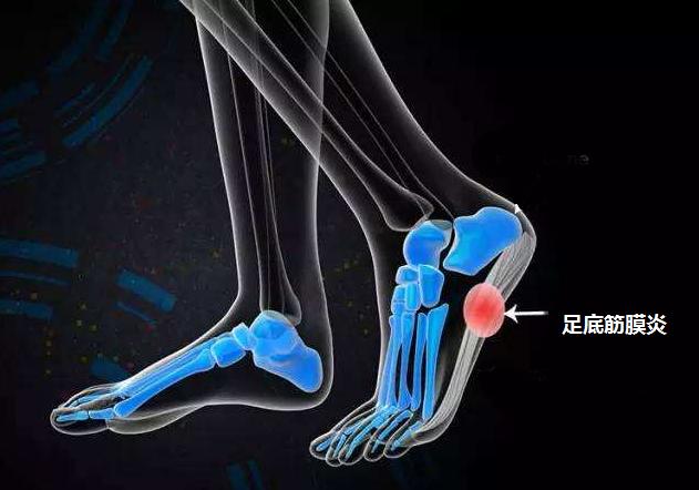 脚后跟长骨刺非常痛应该怎么治疗,脚后跟长骨刺了特别疼怎么治疗