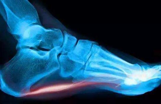 脚后跟疼长了骨刺怎么办,脚后跟痛还有骨刺怎么办啊