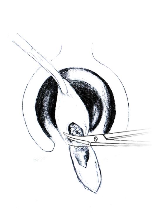 中医肛肠科适宜技术规范,中医肛肠疗法大全