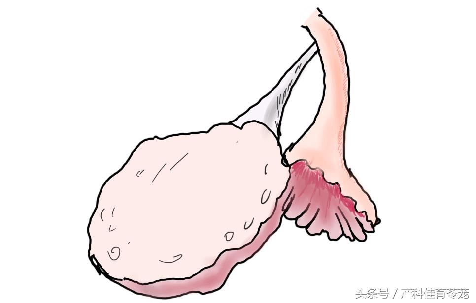 人流对身体损伤最小的方式,人流导致创伤怎么修复