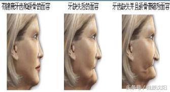 拔牙后一般多久能镶牙,拔牙过后一般多久才能镶牙