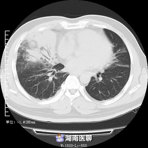 柴油误吸入肺处理,货车司机误吸入柴油