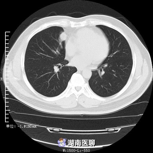 柴油误吸入肺处理,货车司机误吸入柴油