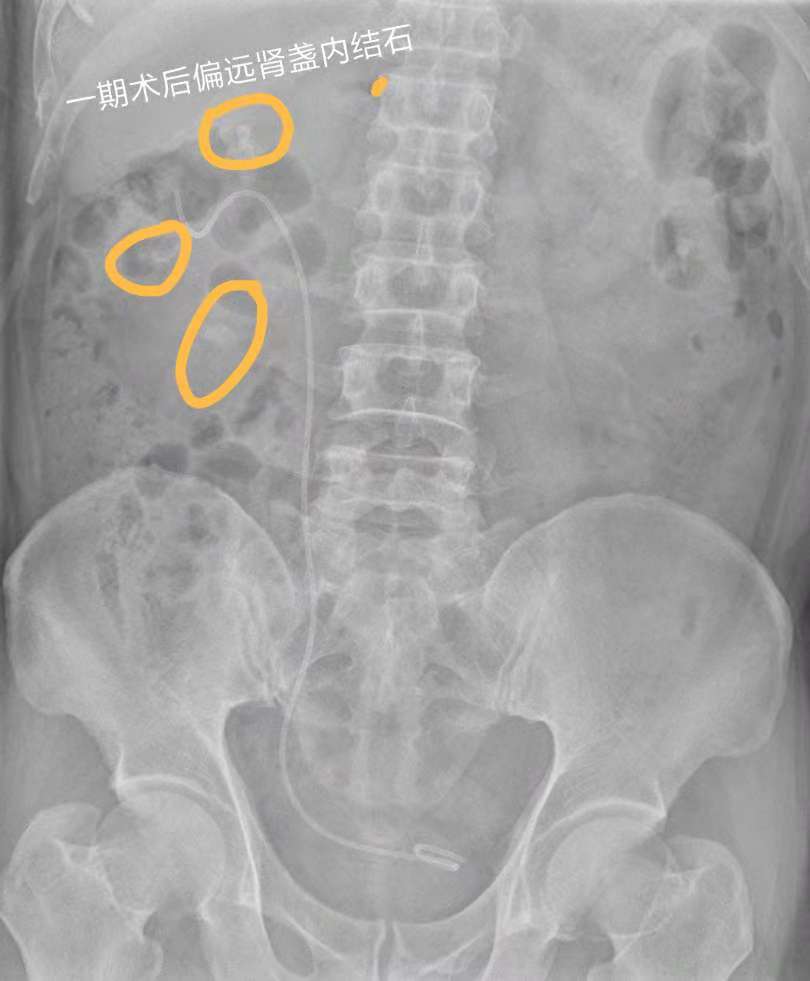 有冶肾结石肾囊肿的好医生吗,肾结石外科手术治疗最新方案