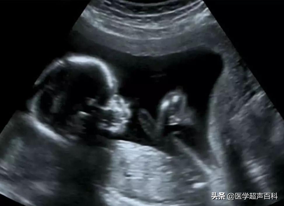 准妈妈们在孕期：B超的一些疑问，给你详细解答