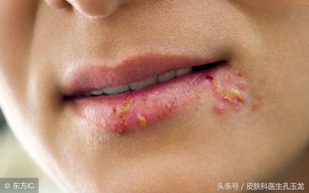 单纯疱疹和上火的区别,脸上的单纯疱疹是上火引起的吗