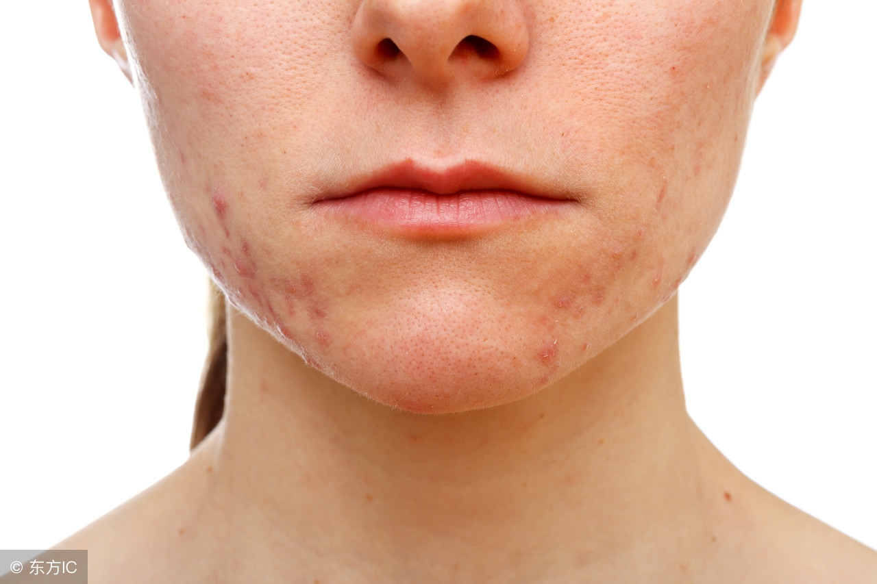 十几年妊娠纹祛疤痕最好的方法,祛疤祛妊娠纹用什么好