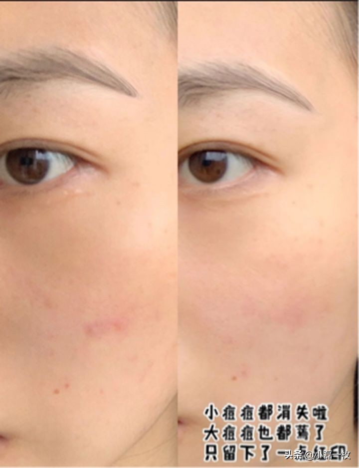 怎么内养皮肤,皮肤粗糙暗黄毛孔粗大怎么内调