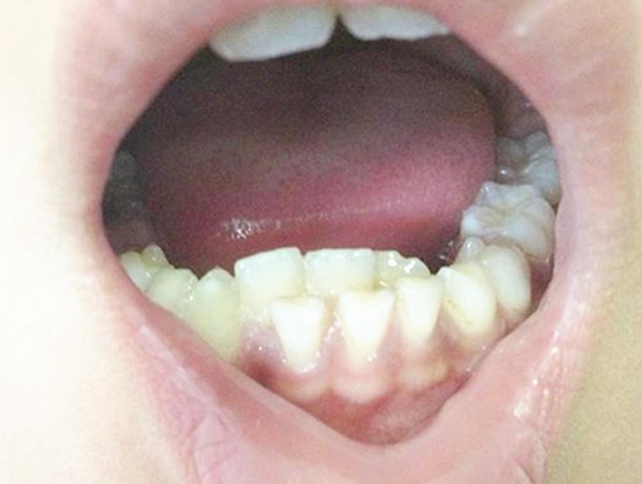 儿童口腔问题盘点，这4大病症最常见，你家孩子牙齿好着没？