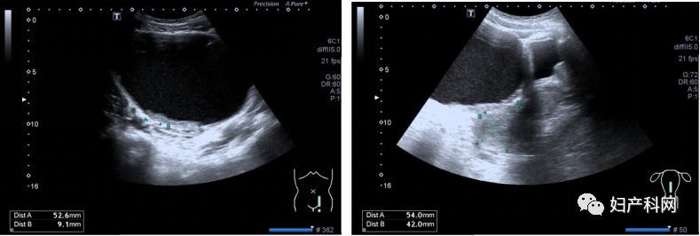 子宫内膜异位囊肿报告如何看,病理报告显示卵巢子宫内膜囊肿