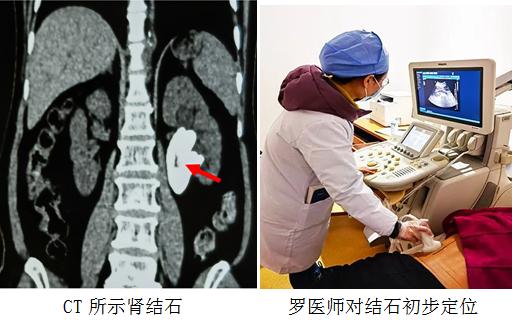 经皮肾镜碎石手术取出的结石,经皮肾镜碎石取石术的病历