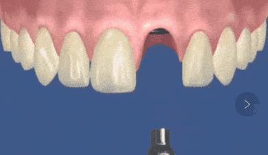 种植牙手术怎么操作,种植牙手术全过程是什么样的