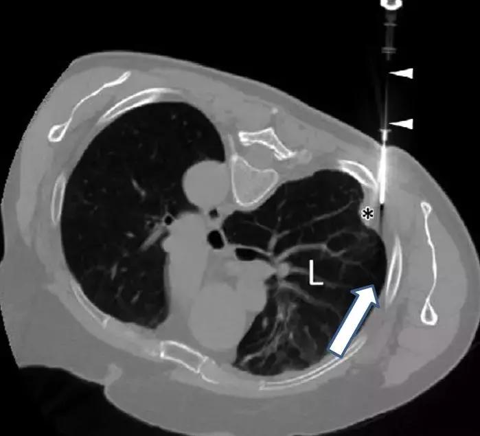 胸部超声引导下穿刺活检术流程,ct引导下肺穿刺活检优缺点