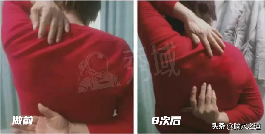 治疗肩颈腰背痛用什么治疗手法,肩颈腰疼痛一招搞定