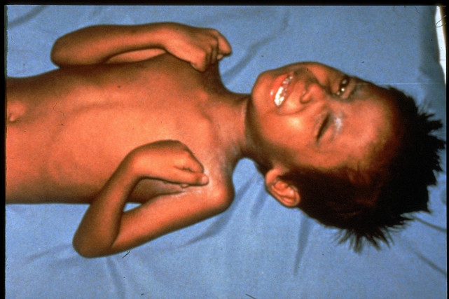 破伤风有多可怕？曾差点毁掉美国的独立日！但那不是铁锈造成的