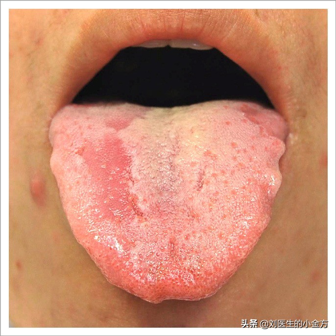 中医舌诊图解100例,中医舌诊图与舌诊口诀