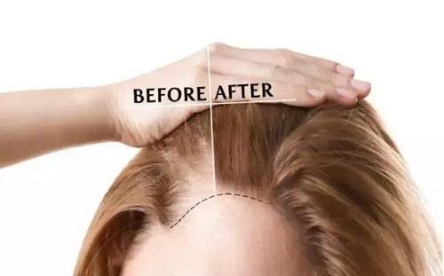 毛囊萎缩是个什么样的过程呢？为什么发量会日渐减少？