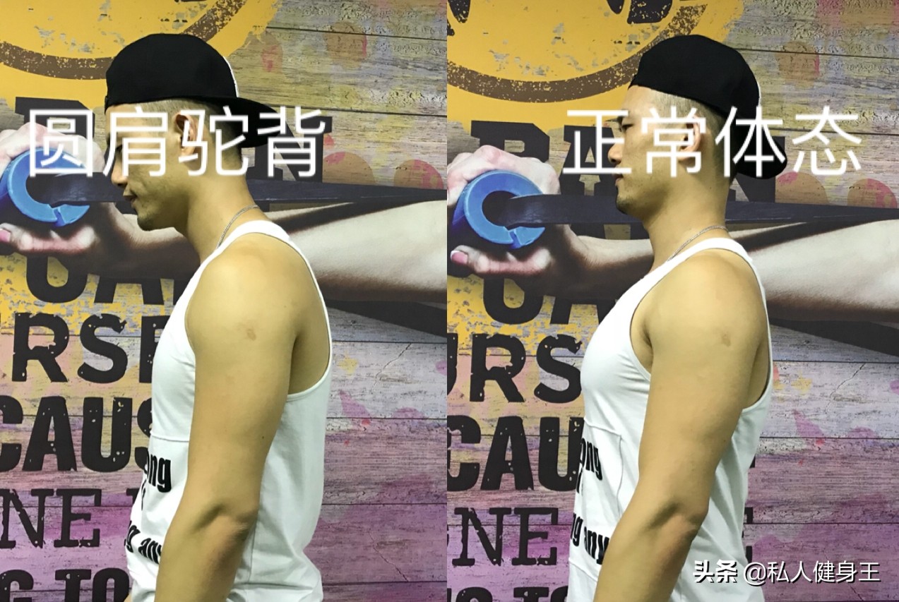 你有什么方法能改善驼背,如果你有驼背现象该怎么办