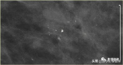 乳腺钙化怎么区分良性和恶性,乳腺钙化的诊断与分级