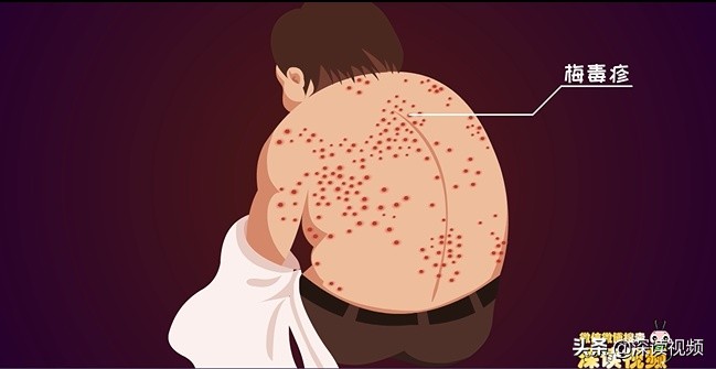 梅毒上热搜，隐私部位出现啥样要警惕？