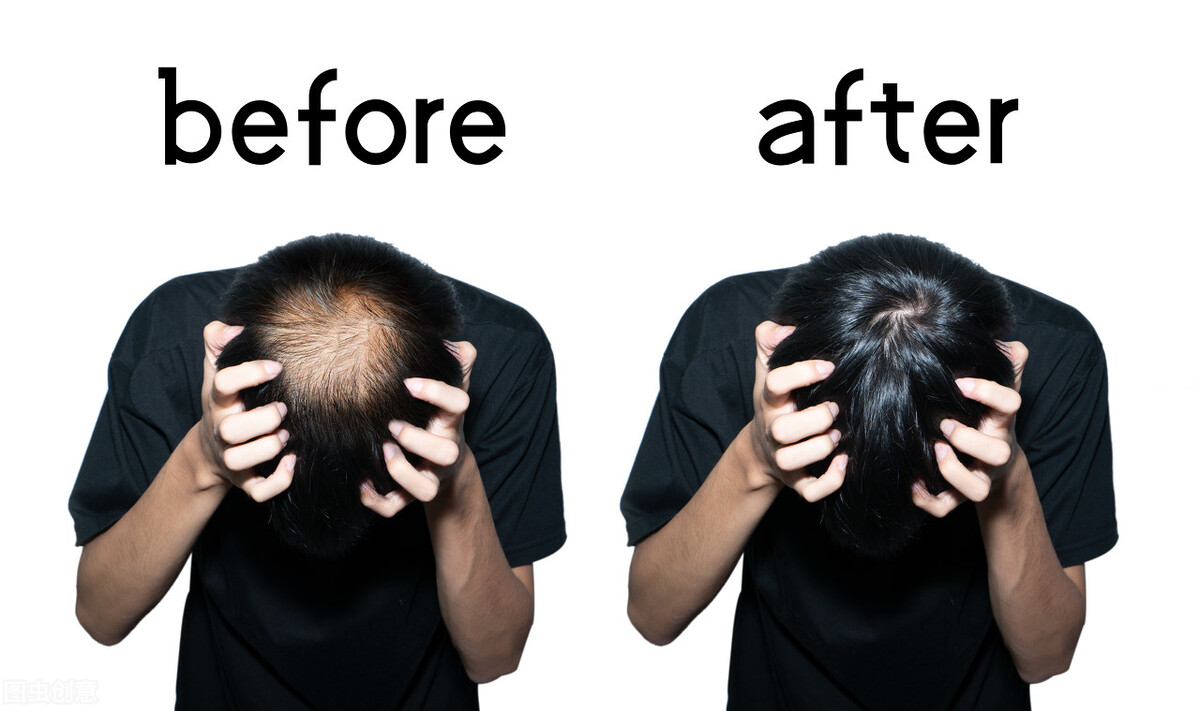 做植发标准流程是什么样的,植发必须去医院做吗